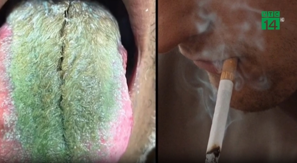 Lưỡi chuyển màu xanh sau khi dùng thuốc kháng sinh và hút thuốc lá